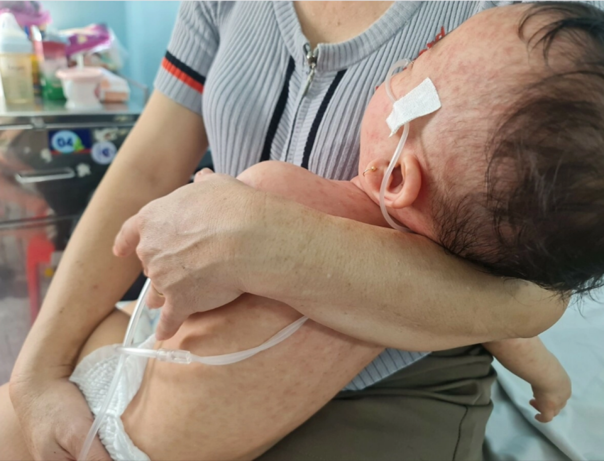 Nhiều trẻ phải thở máy do biến chứng viêm phổi do sởi