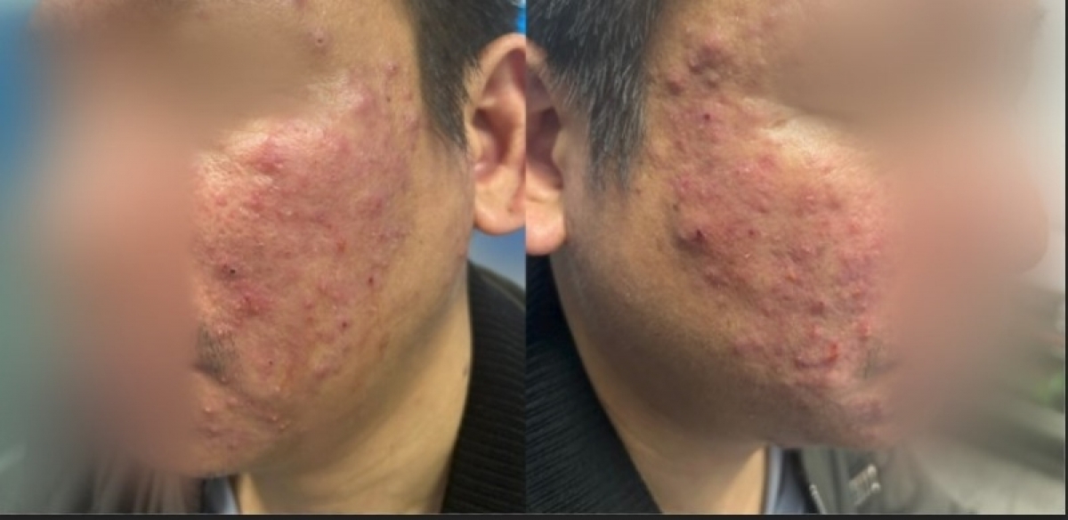 Da bệnh nhân B. xuất hiện nhiều vùng mẩn đỏ kèm tình trạng ngứa. Ảnh BV cung cấp