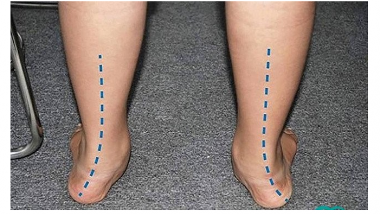 Hội chứng bàn chân bẹt ở trẻ nhỏ