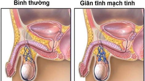 Vô sinh, hiếm muộn do giãn tĩnh mạch thừng tinh có thể điều trị được