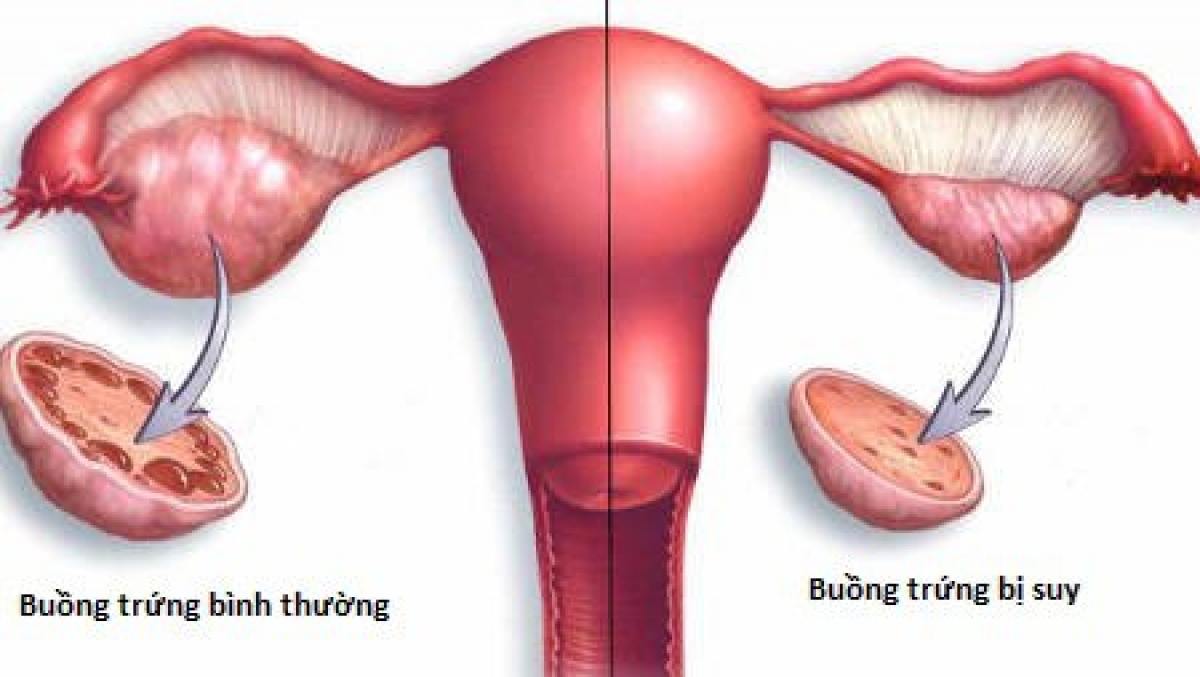 suy buồng trứng sớm