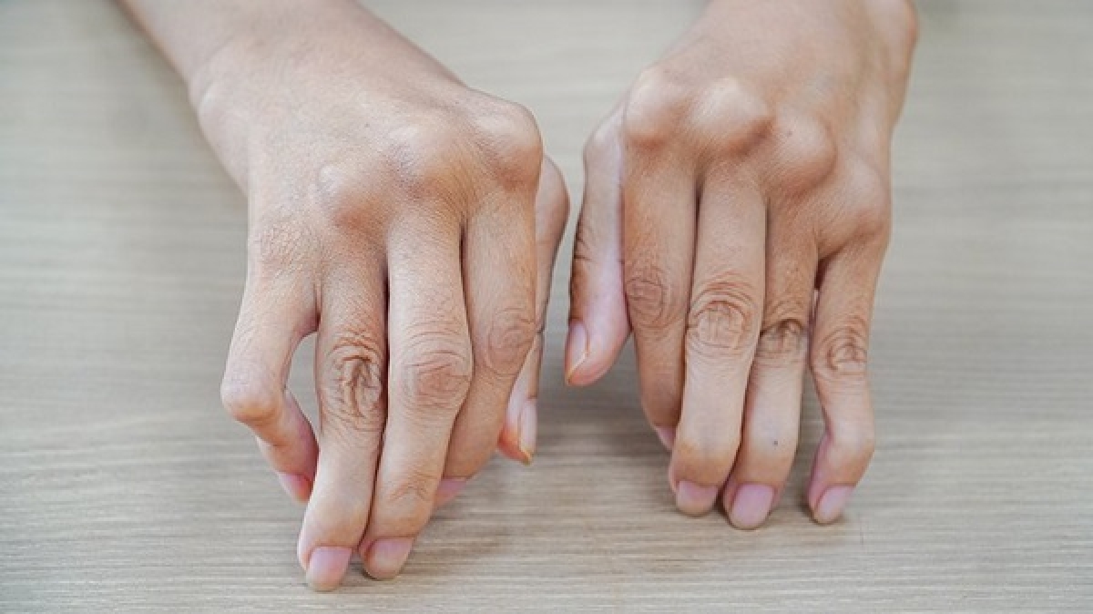 Đôi bàn tay co quắp, vẹo vọ của bệnh nhân Trần Thị Ánh trước khi phẫu thuật