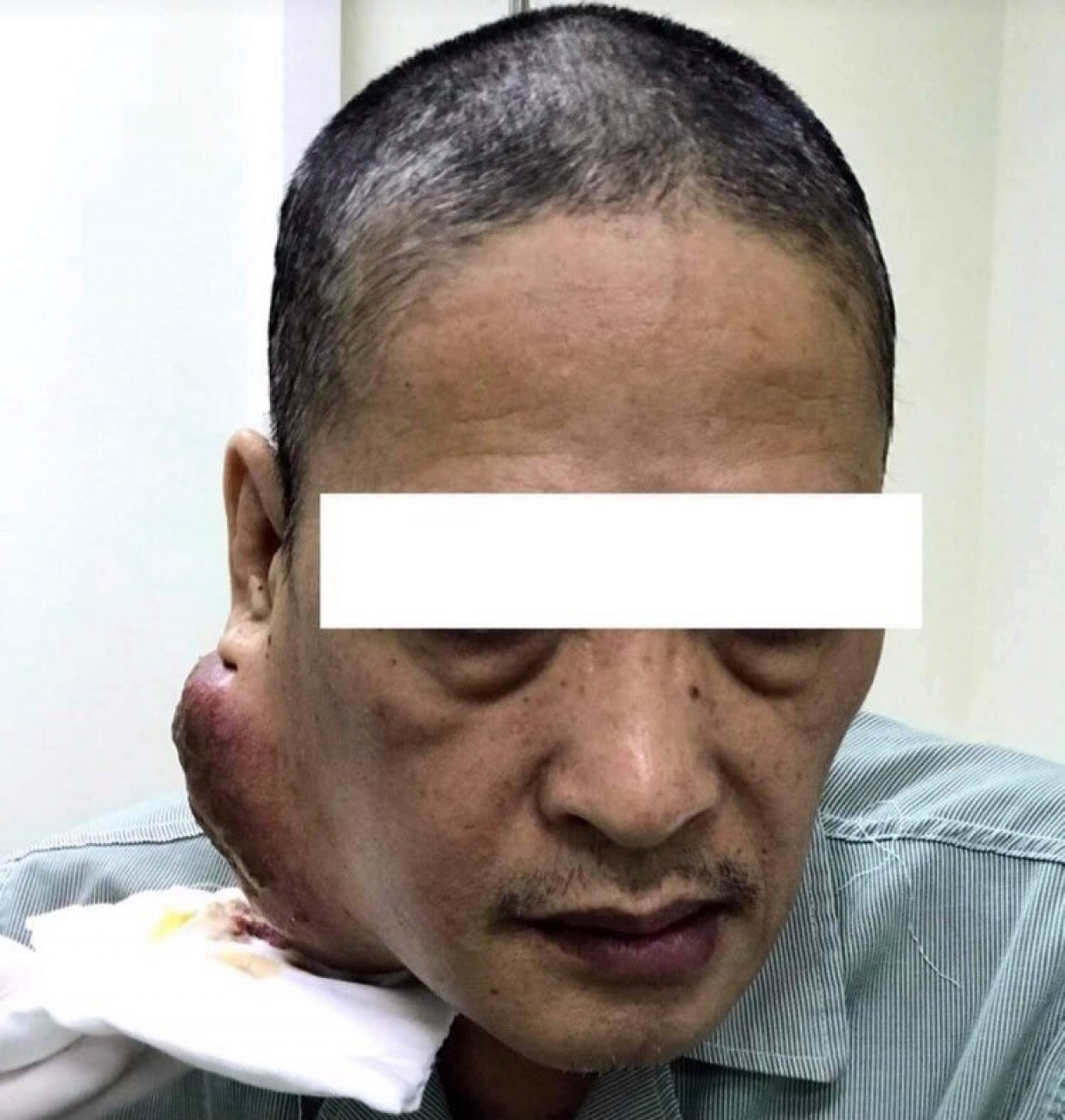 Khối u sưng tấy và chảy mủ của ông L.