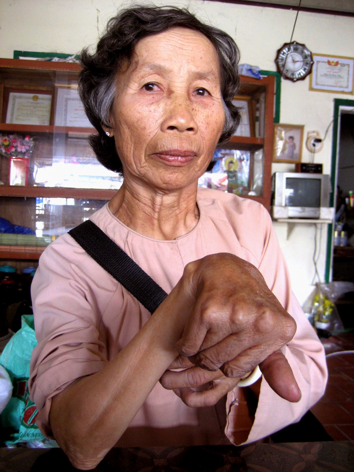 CCB Đặng Thị Bảy và thương tật trên cơ thể