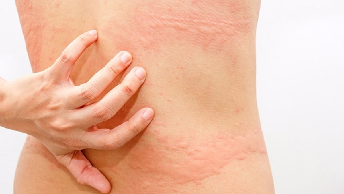Dấu hiệu mẩn ngứa, nổi mề đay khi bị dị ứng thực phẩm