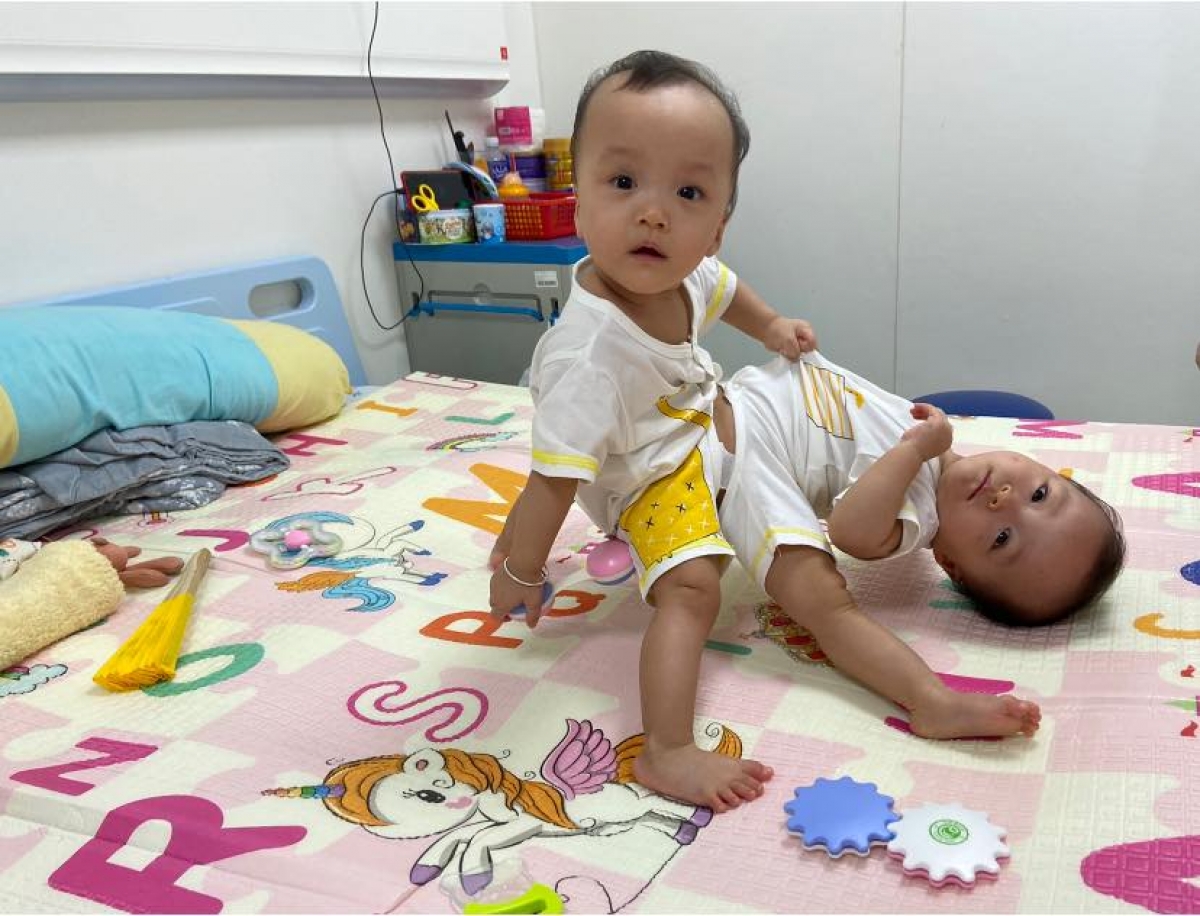 Song Nhi trước khi được phẫu thuật tách rời. Nguồn ảnh: BV Nhi đồng TP