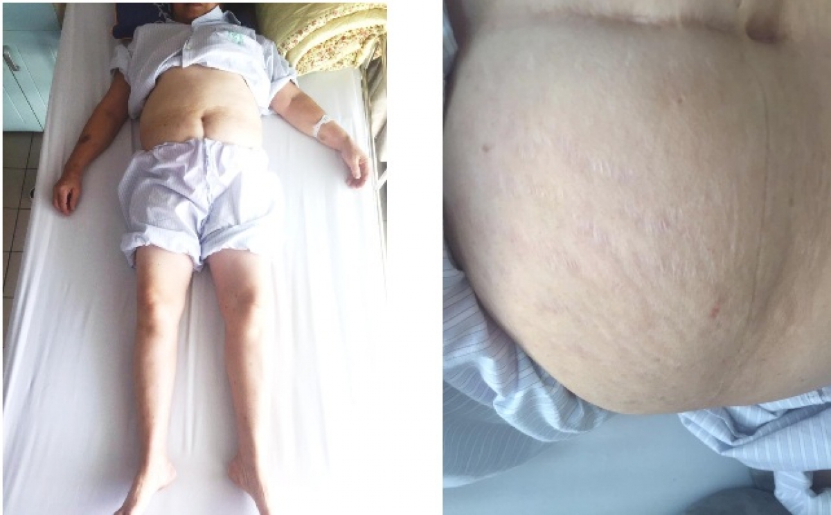 Bệnh nhân teo cơ, rạn da do lạm dụng corticoid