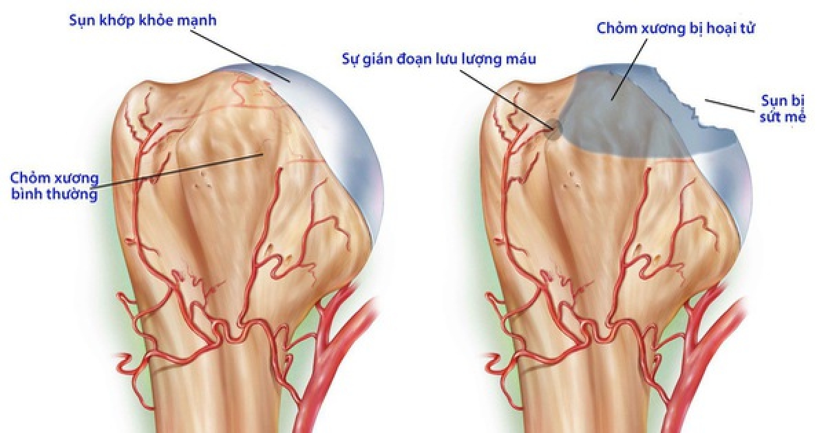 Hình ảnh khớp háng thoái hóa do hoại tử chỏm xương đùi
