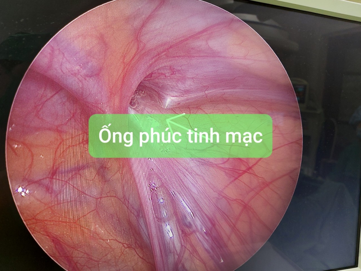 Ống phúc tinh mạc dưới hình ảnh nội soi