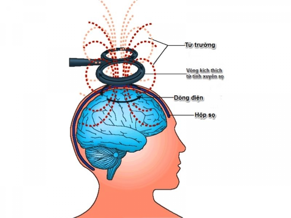Nguyên lý hoạt động của máy kích thích từ xuyên sọ tác động vào các tế bào não