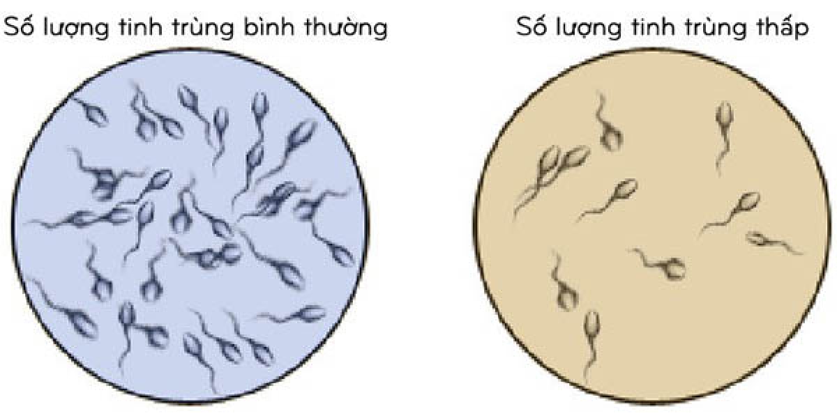 Phân biệt tinh trùng bình thường và tinh trùng yếu