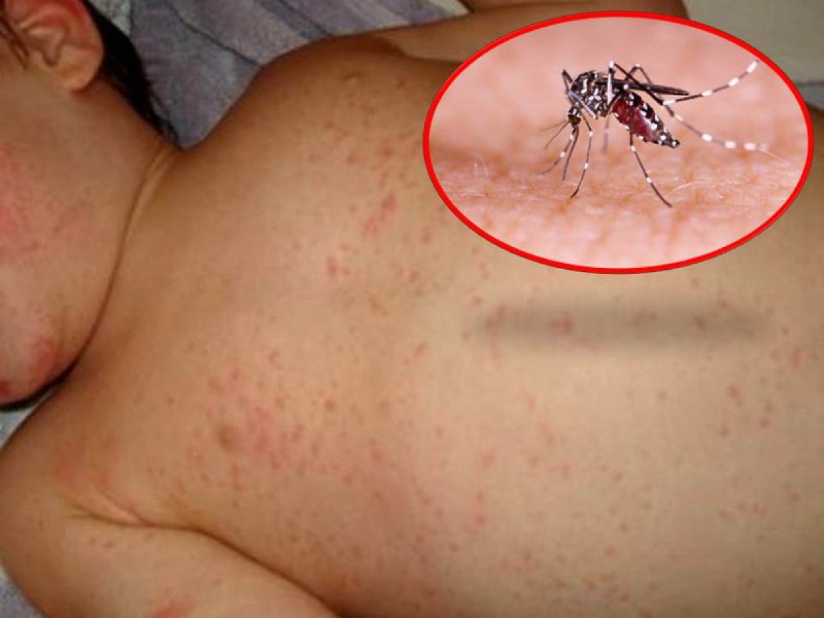 Dịch sốt xuất huyết ở TP.HCM vào "mùa" sớm hơn so với mọi năm