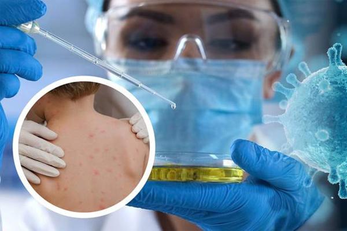 Người bị bệnh đậu mùa khỉ có thể bị phát ban