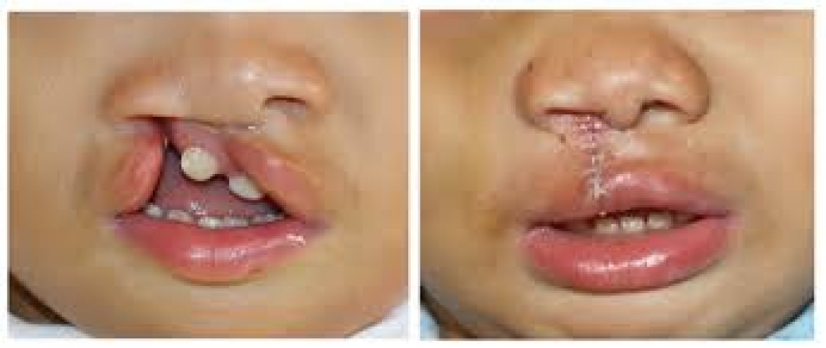 Tại Việt Nam, cứ 700 trẻ sinh ra thì có 1 trường hợp bị khe hở môi, vòm miệng và dị tật hàm mặt