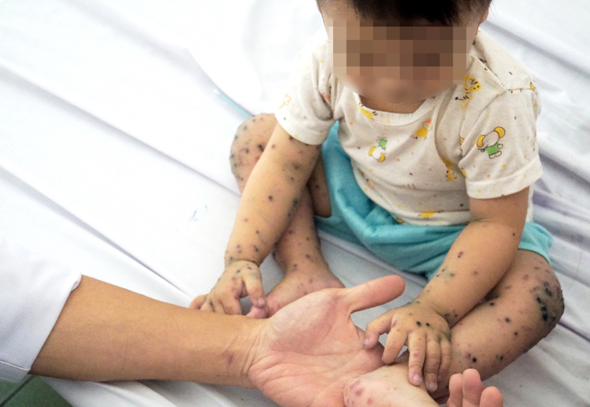 Người nhà lo ngại COVID-19 và nghĩ là thủy đậu, bé trai nhập viện điều trị tại Khoa Nhiễm Bệnh viện Nhi Đồng 2 muộn, khi mụn nước nổi kín người