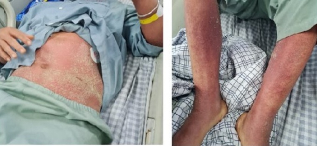 Người bệnh nổi ban toàn thân sau nhiễm liên cầu lợn. Ảnh: Bệnh viện cung cấp