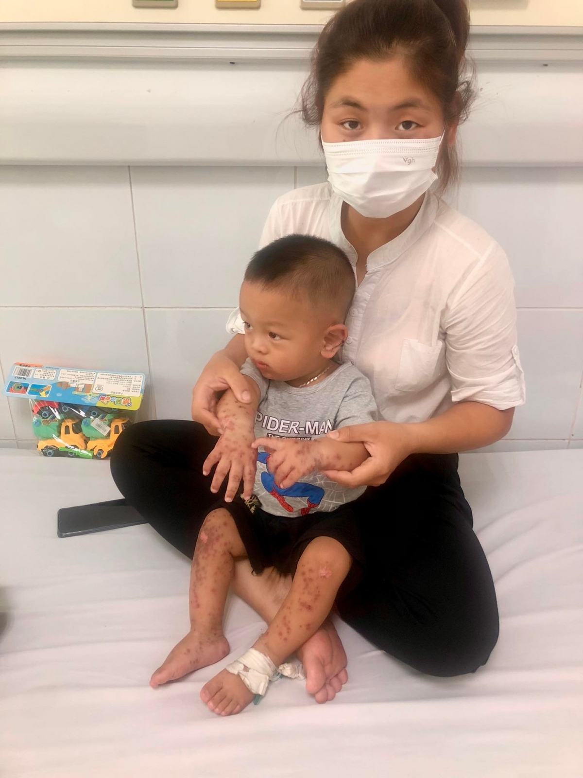 Toàn thân cháu Gia Huy nổi nhiều nốt ban
