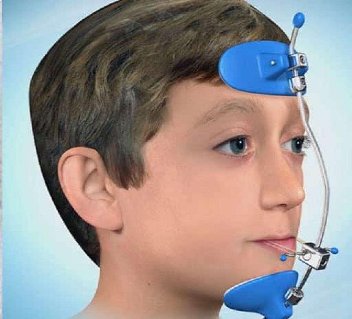 Facemask là 1 khí cụ chỉnh hình giúp phát triển xương hàm trên ra trước một cách hiệu quả