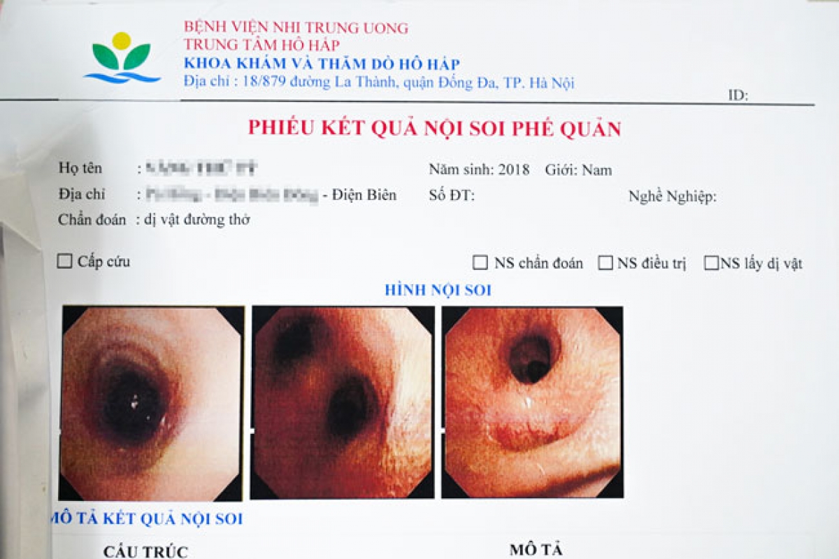 Hình ảnh nội soi phế quản của bệnh nhi- Ảnh bệnh viện