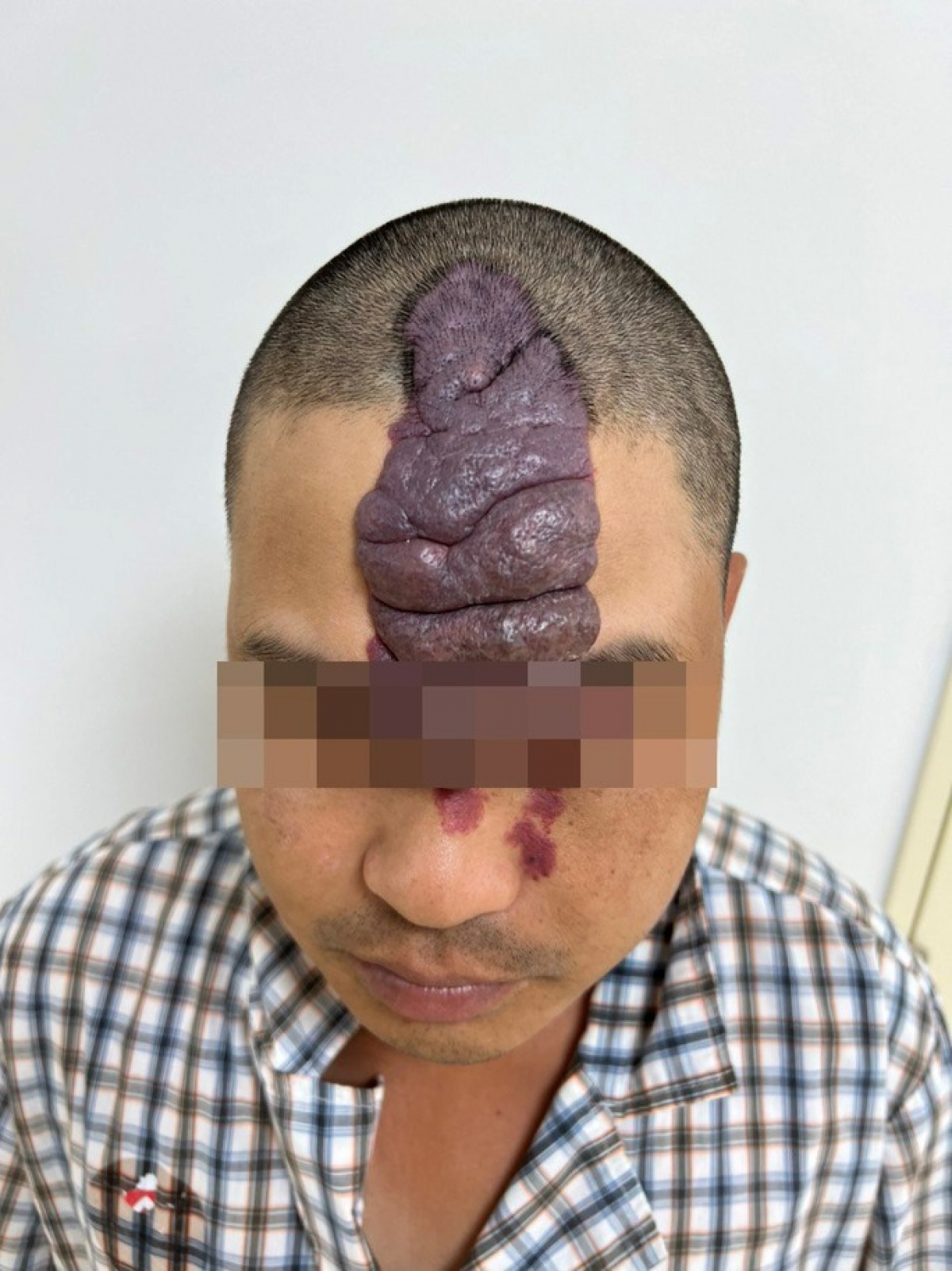 Khối dị dạng mạch máu với kích thước khổng lồ chiếm một phần khuôn mặt anh T.