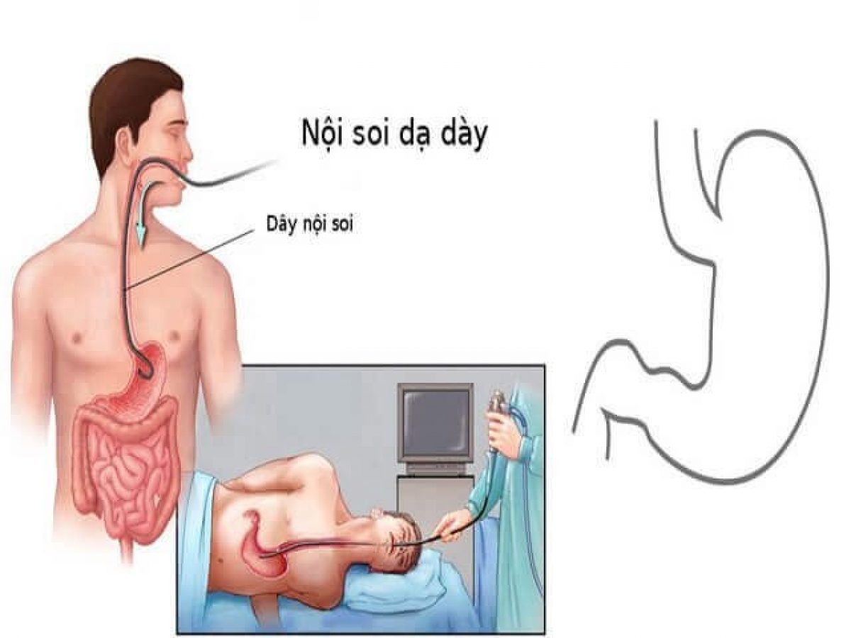 Nội soi là tiêu chuẩn vàng trong chẩn đoán bệnh viêm loét dạ dày tá tràng hiện nay và không gây ảnh hưởng đến sức khỏe
