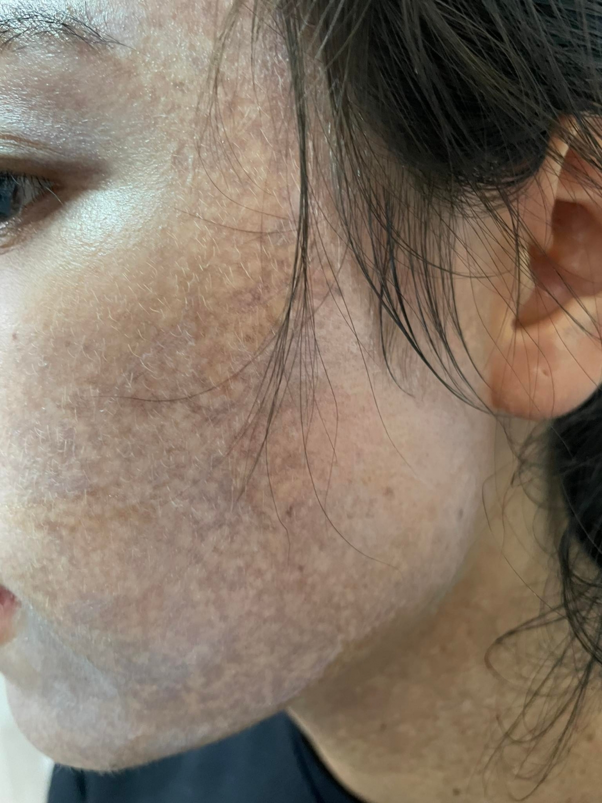 Khuôn mặt cô gái trẻ trở nên loang lổ do làm đẹp tại cơ sở không đảm bảo an toàn.