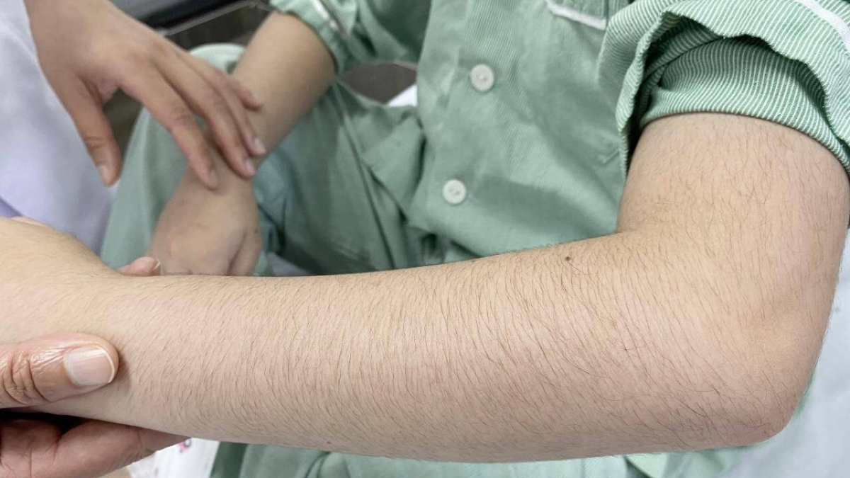 Tay rậm lông - một trong những dấu hiệu trẻ bị suy tuyến thượng thận do corticoid