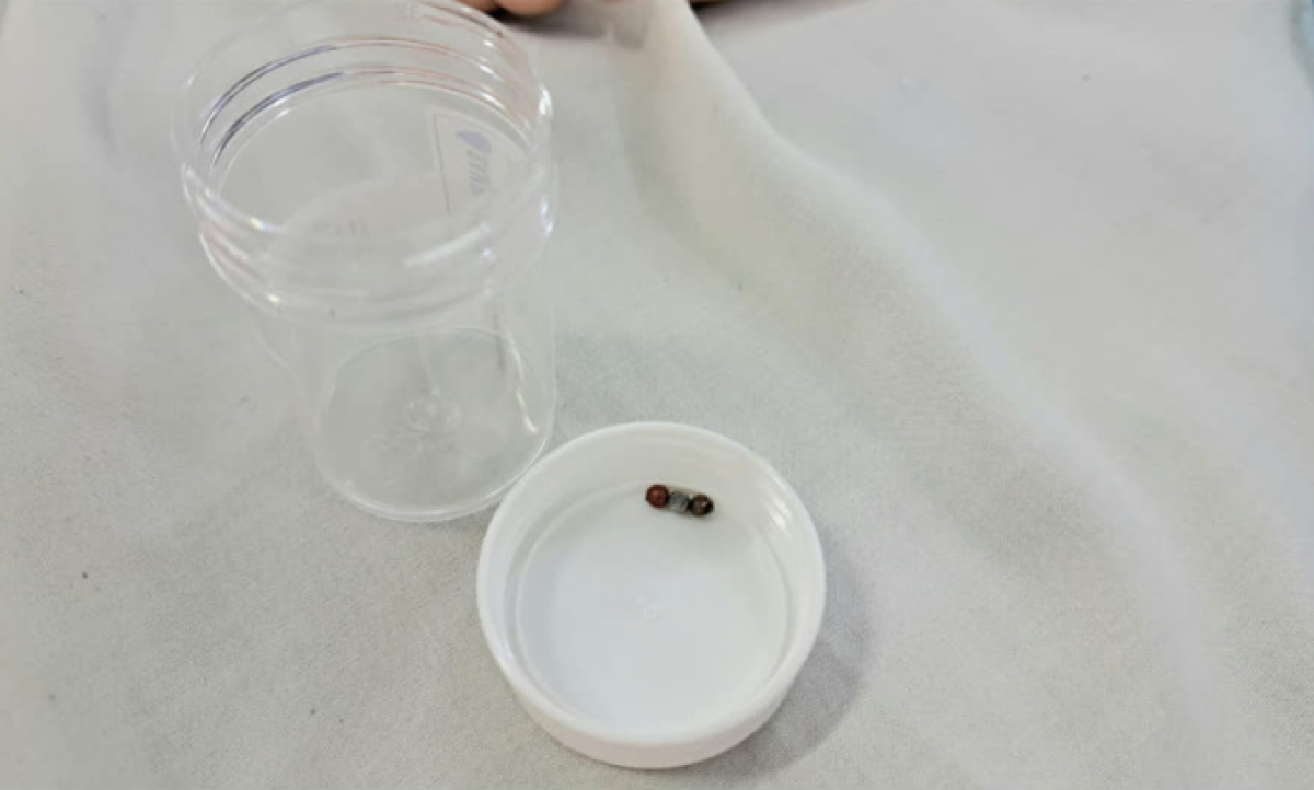 Hình ảnh 3 viên bi được các bác sĩ gắp ra trong ruột bệnh nhân