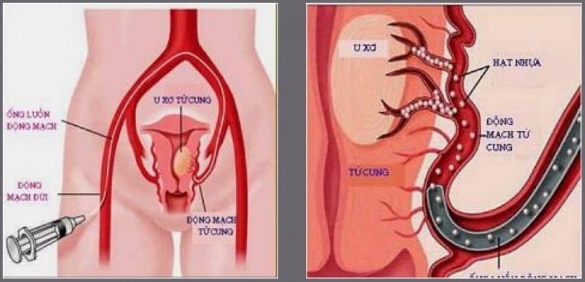 Phương pháp can thiệp nút mạch giúp bệnh nhân không cần phẫu thuật và bảo tồn được tử cung