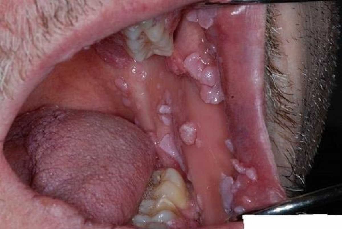 Sùi mào gà ở miệng của một nam quan hệ đồng giới