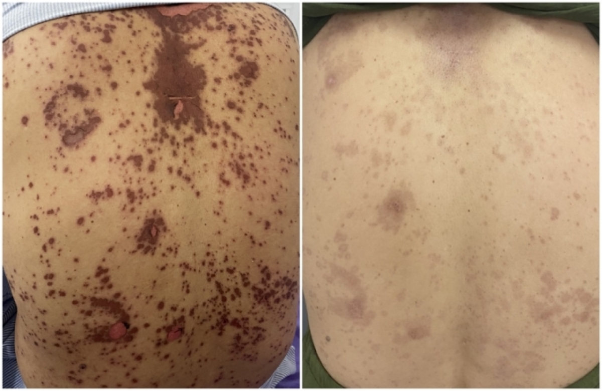Các vết ban đỏ thâm tím mờ dần sau điều trị. Ảnh: Bệnh viện cung cấp