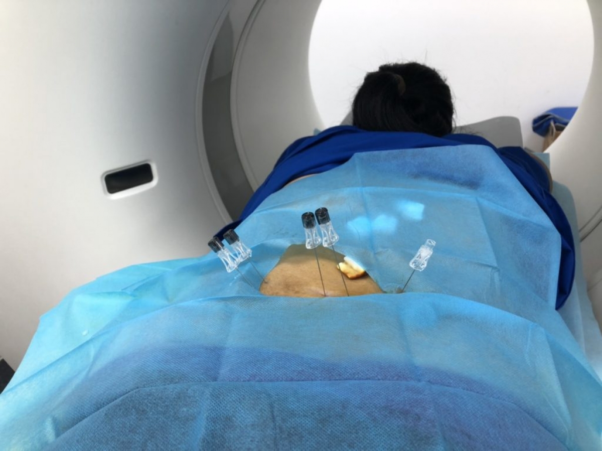 Người bệnh đang được định vị kim tại các vị trí tiêm Ozone trong điều trị thoát vị đĩa đệm