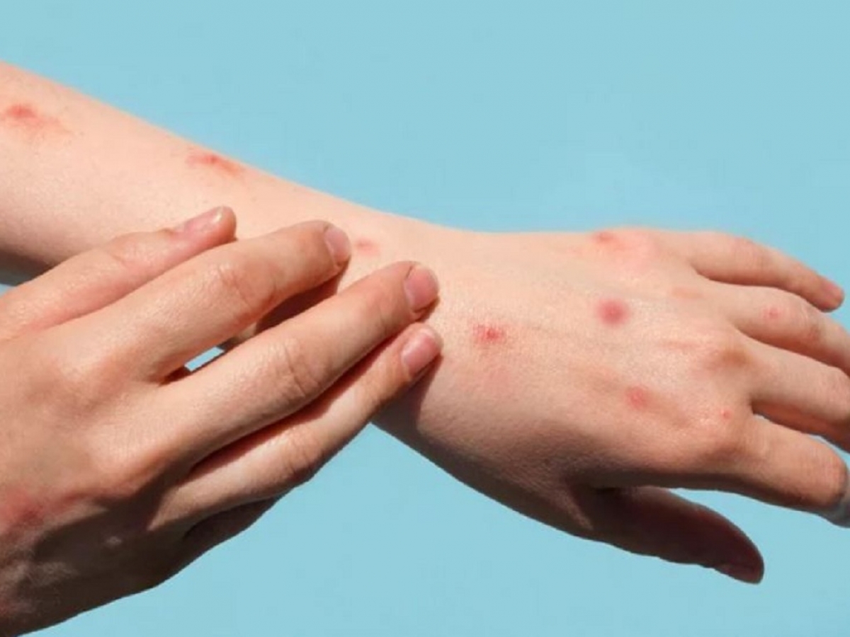 Đến hôm nay, bệnh nhân phục hồi sức khỏe, PCR dịch tiết 1 số vị trí kiểm tra hiện đã âm tính.