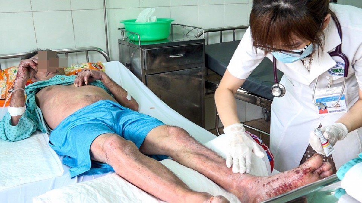 Nhiễm nấm làm tình trạng bệnh nhân HIV nặng nề hơn