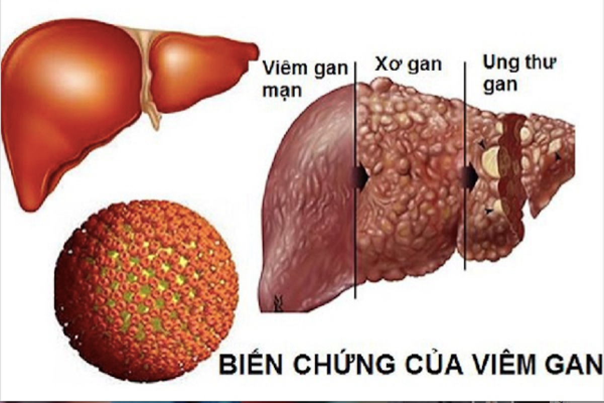 Bệnh viêm gan virus có thể gây ra những hậu quả nghiêm trọng
