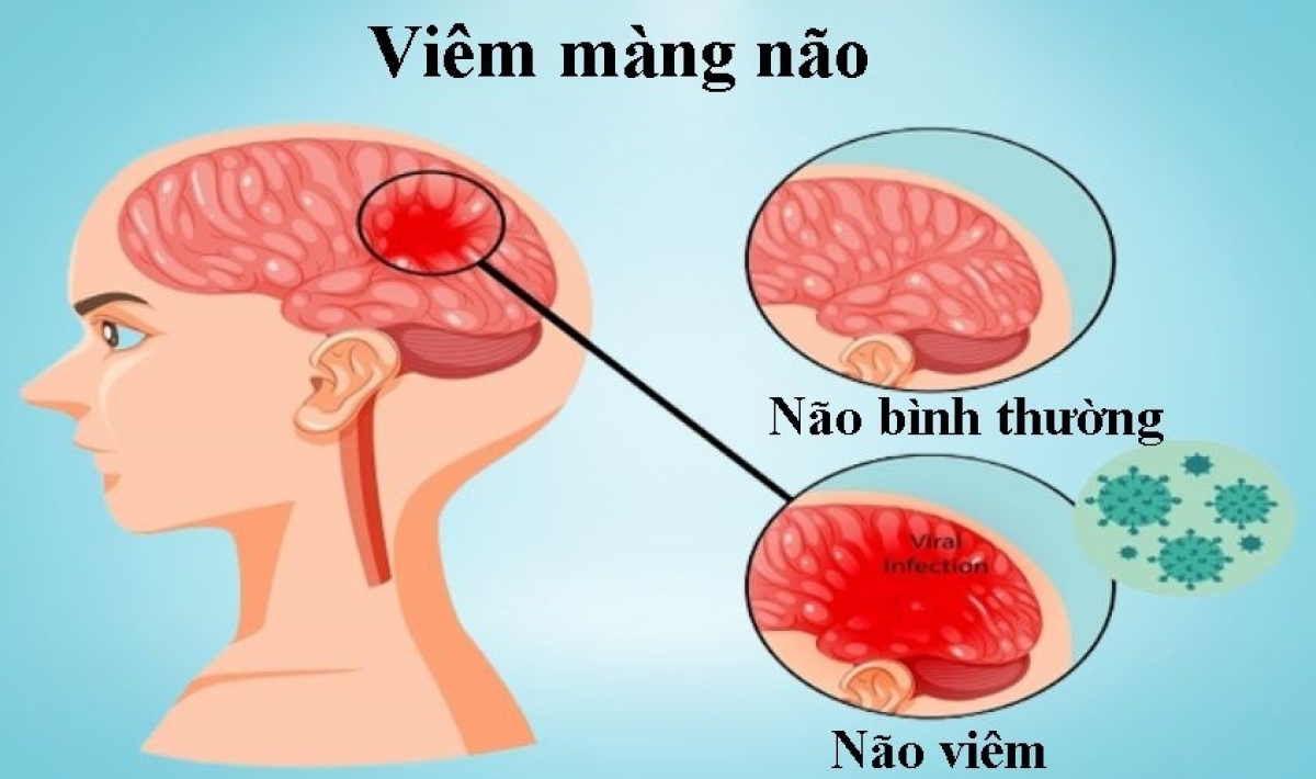 Viêm màng não là căn bệnh nguy hiểm, có thể để lại di chứng nếu không phát hiện và điều trị sớm