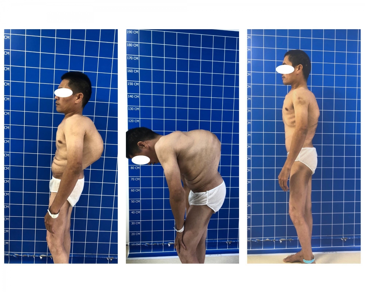 Bệnh nhân trước phẫu thuật (ảnh 1,2) và sau phẫu thuật (ảnh 3)