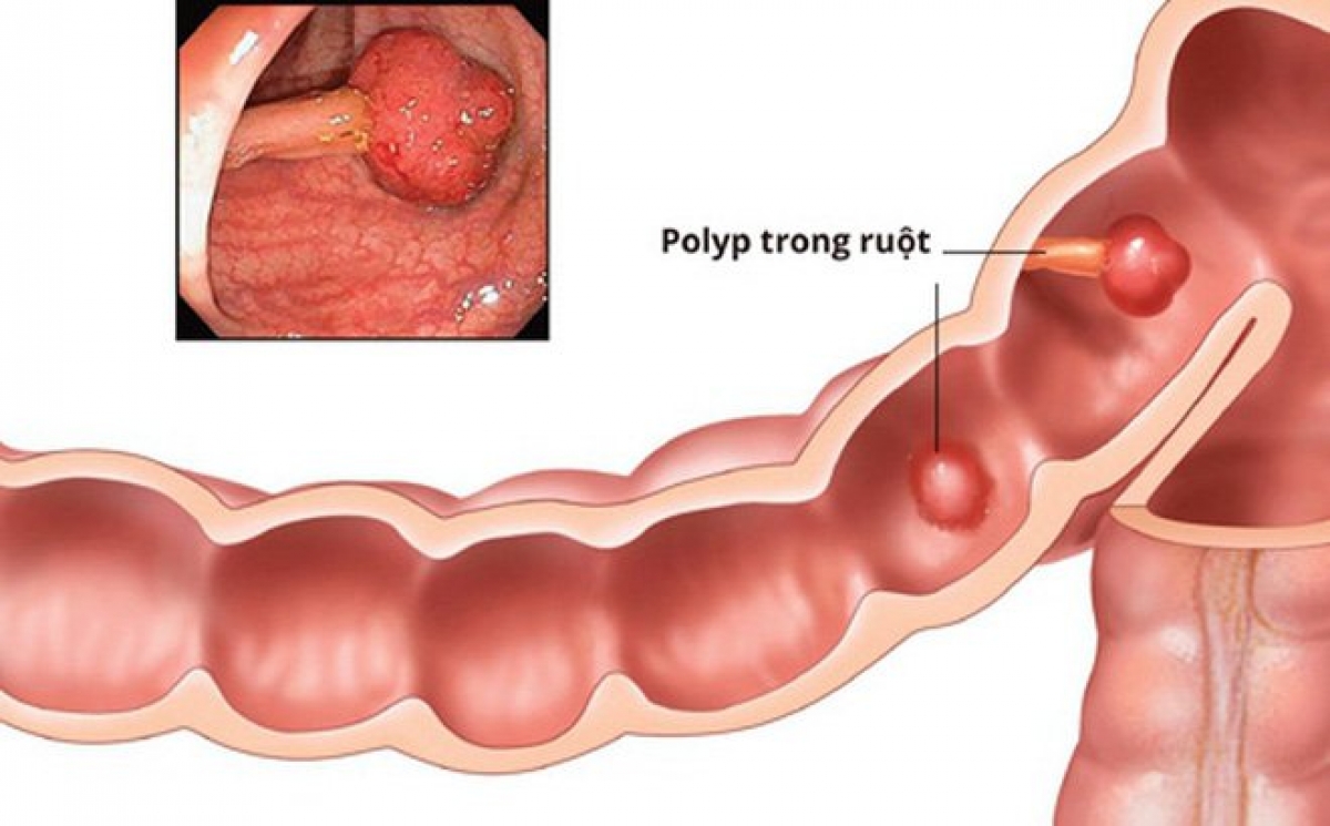 Polyp trong ruột của trẻ