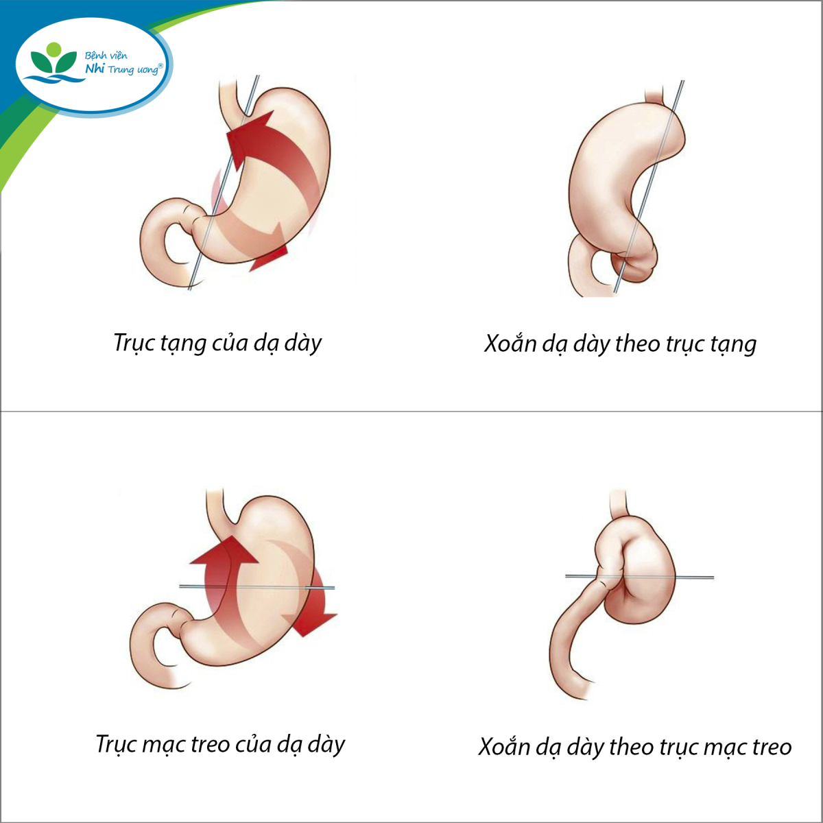 Hình ảnh mô tả các dạng xoắn dạ dày