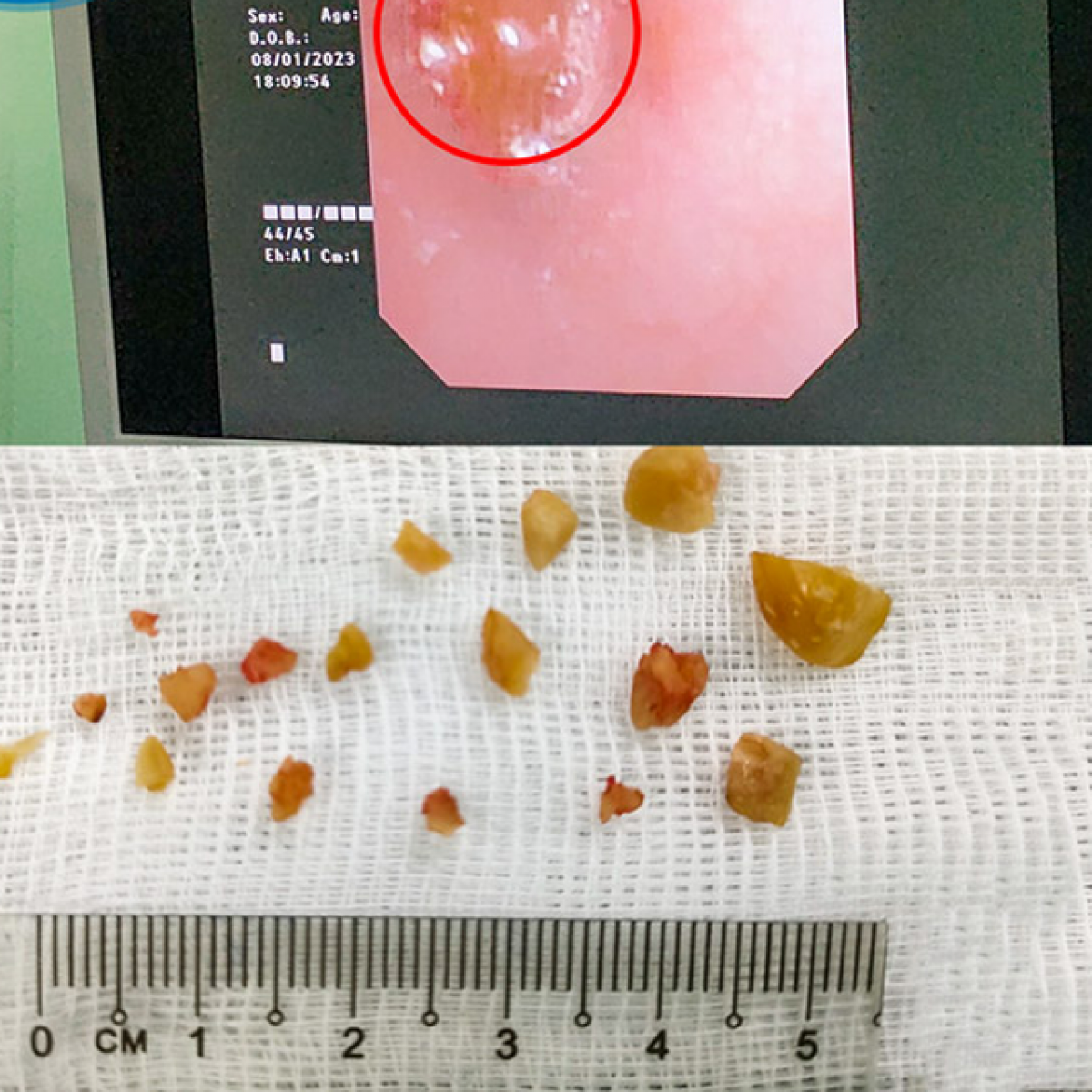 Hình ảnh hạt lạc mắc trong phế quản của trẻ đã được gắp ra ngoài sau khi phá thành nhiều mảnh nhỏ