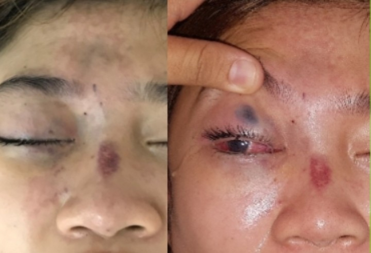 Nhiều ca tiêm filler làm đẹp biến chứng mù mắt
