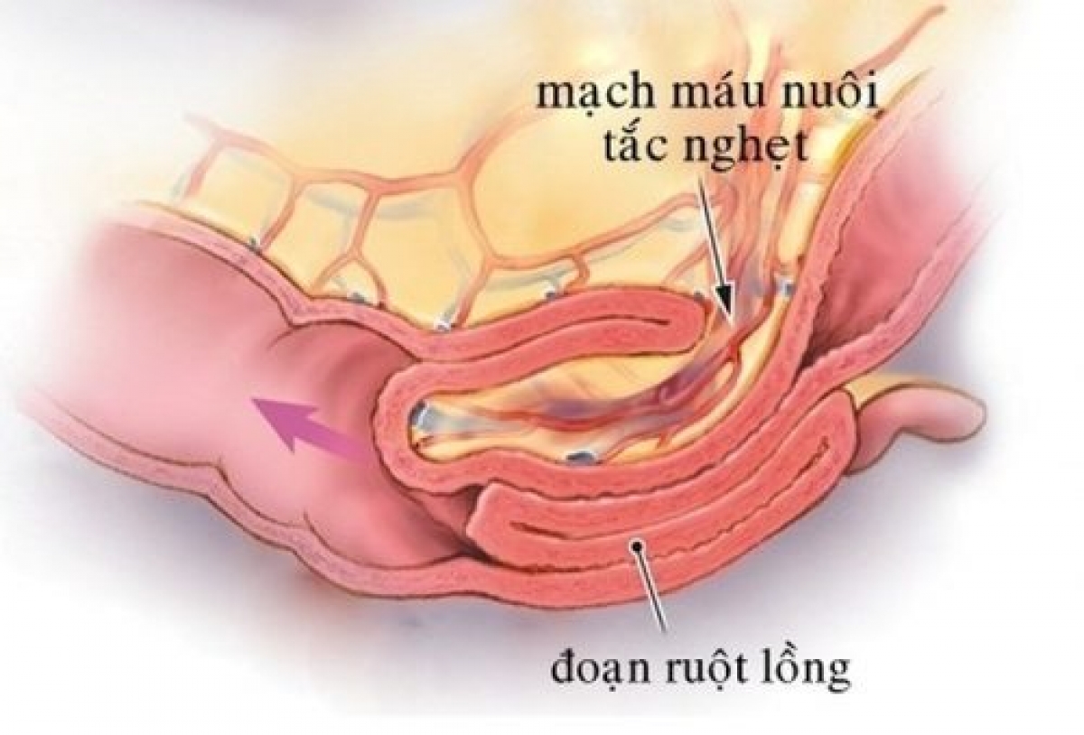 Hình ảnh đoạn ruột lồng gây tắc ruột