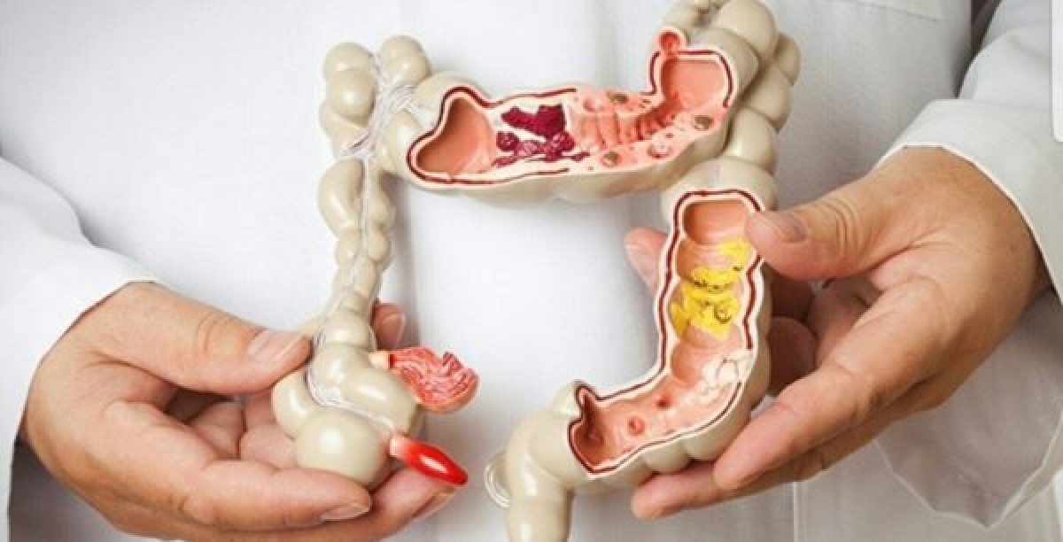 Chế độ ăn thiếu chất xơ là một trong những nguyên nhân gây táo bón chức năng.