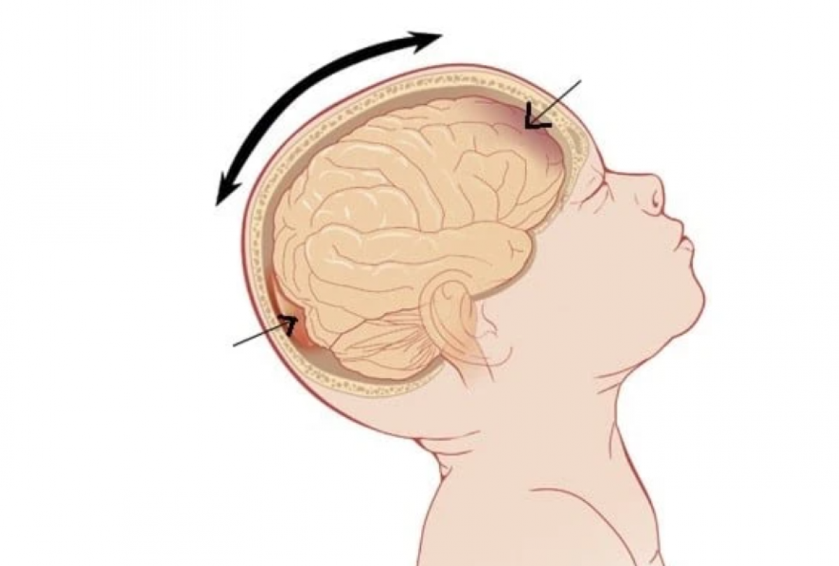 Tuyệt đối không rung lắc trẻ nhỏ