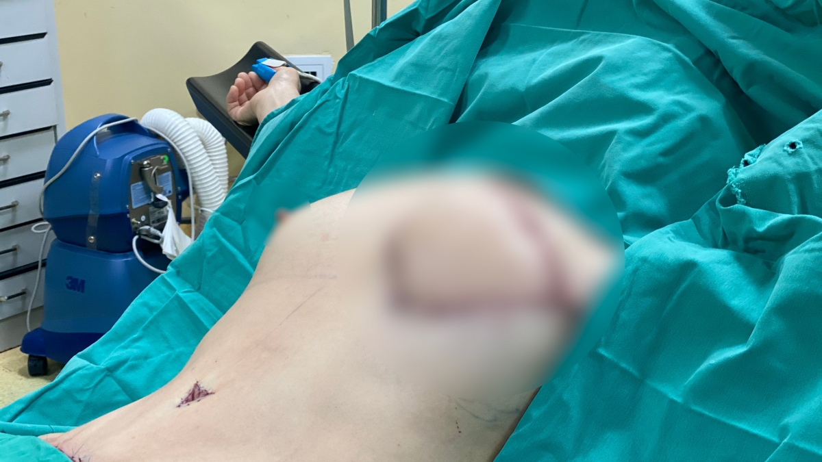 Tạo hình vú cho bà Bé thành công mang lại vẻ đẹp tự nhiên