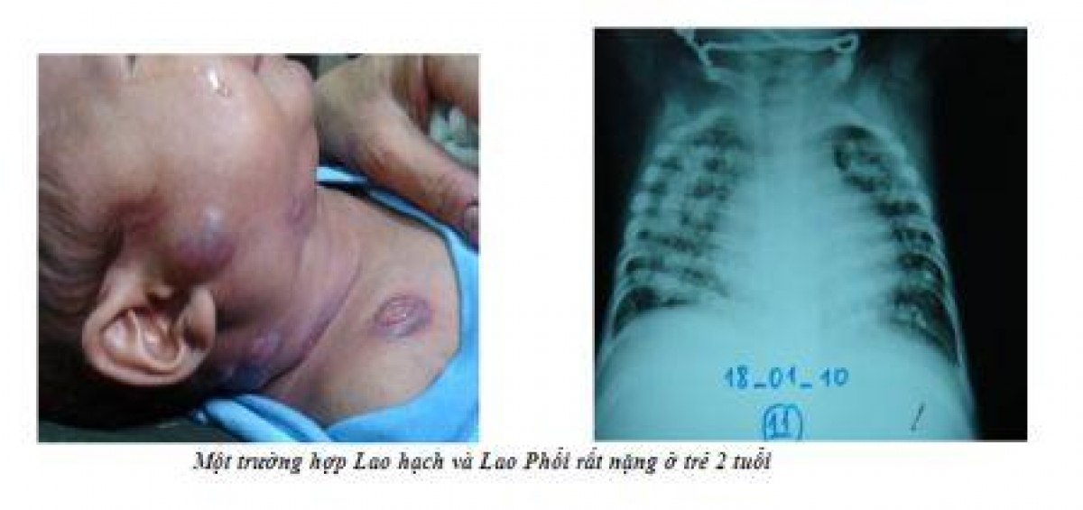 Trẻ em là đối tượng dễ bị bệnh lao tấn công