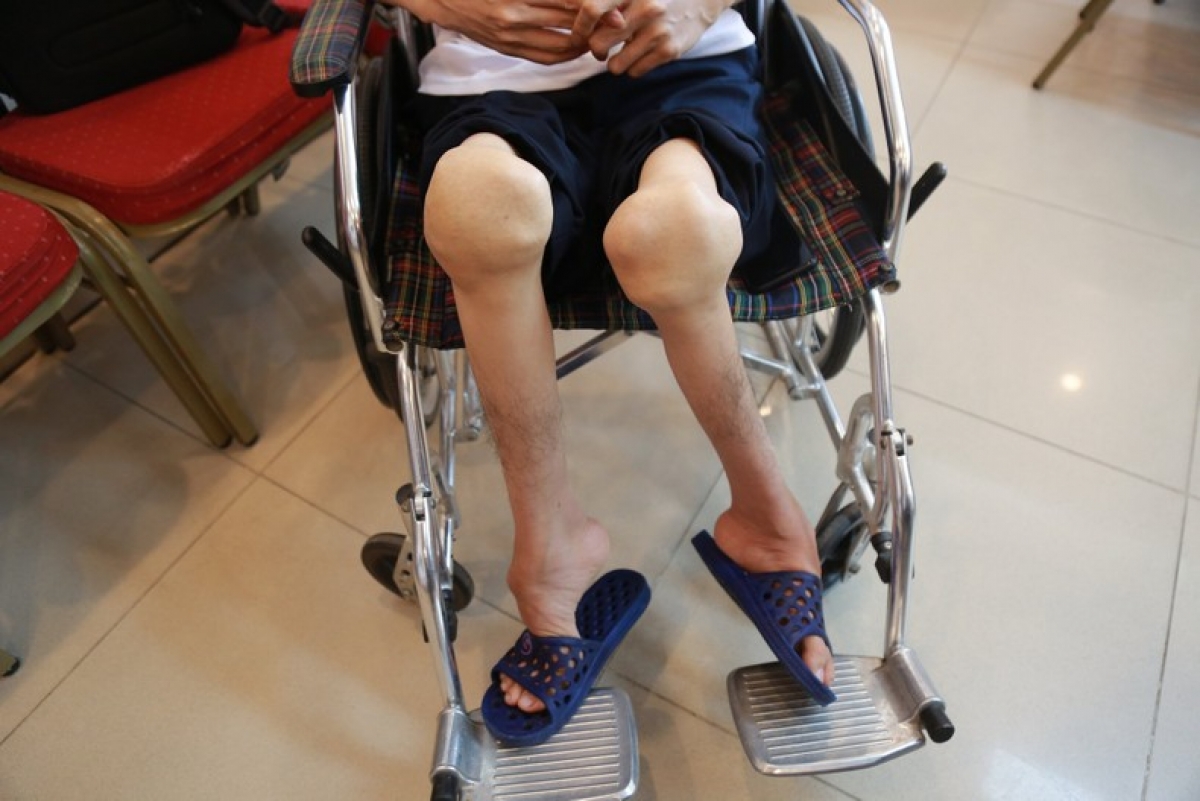 Bệnh nhân hemophilia có nguy cơ tàn tật cao nếu không được phát hiện sớm và điều trị đúng cách