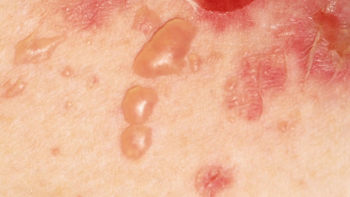 Các vết phồng rộp và trợt da ở bệnh nhân Pemphigus