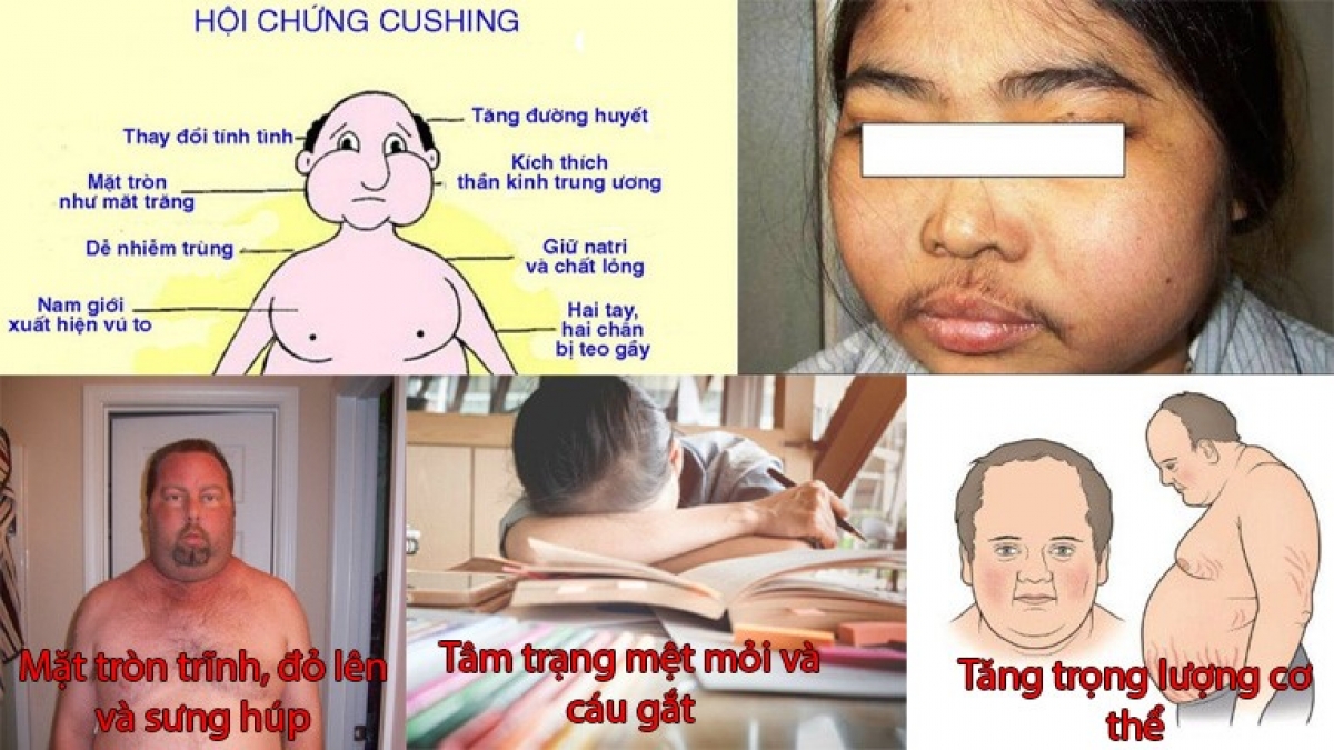 Các tác dụng phụ nguy hiểm do corticoid gây ra