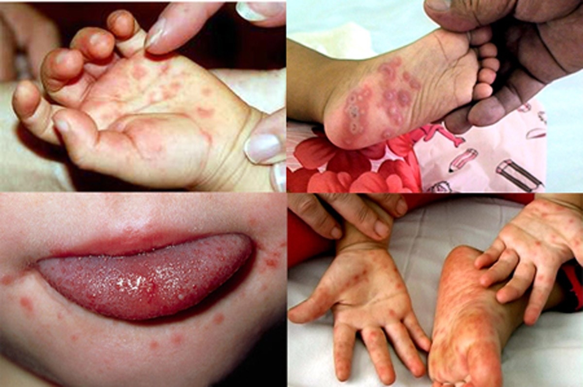 Các nốt phỏng nước ở tay, chân, miệng của trẻ là dấu hiệu nhận biết sớm bệnh